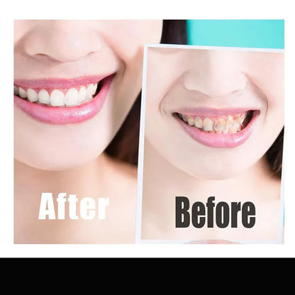 Black Whitening Strips – Fast & Effective Teeth Whitening Without Sensitivity (14pcs)